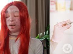 26-летняя трансженщина из Польши годами сама себе колола силикон: что произошло с ее лицом. Жуткие фото