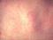 In Kiev, a measles outbreak in children