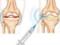 Як лікувати остеоартрит колінного суглоба без оперативного втручання?
