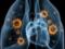 Ученые научились определять туберкулёз по дыханию