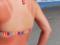 Suprun told how to treat sunburn