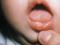 Sore mouth ulcers in children: the causes of how to treat yourself