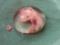 Эмбрион в эмбрионе: у девушки в животе нашли ее близнеца