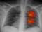 Вчені знайшли продукти, які захищають від раку легенів