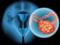 Найдены 6 типов клеток, вызывающих рак яичников