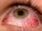 Симптомы: что известно о глазном гриппе, от которого нет лекарств