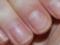 The podiatrist explained what white stripes on the nails can signal