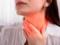 Doctor Agapkin: a sore throat cannot be treated with hot tea