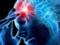 Doctors overcame 4 signs of ischemic stroke
