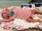 For the first time, an operation was performed on the brain of a child before his birth
