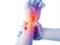 Therapy for gout: symptoms, causes and treatment